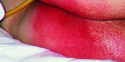 Inkontinenz-Assoziierte Dermatitis
