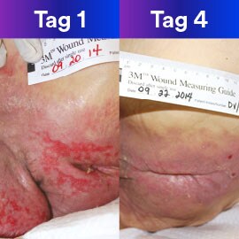  A side by side comparison of a patient on day one and day four.