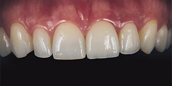 Behandlungsergebnis mit einem Veneer aus Feldspatkeramik und einer handverblendeten Krone mit einem Gerüst aus 3M™ Lava™ Frame Zirkoniumoxid.

