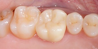 Monolithische Krone aus 3M™ Lava™ Esthetic fluoreszierendem Vollzirkoniumoxid nach dem Einsetzen.
