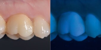 Laterale Ansicht der monolithischen Krone auf dem ersten Molar (links).  Aufnahme unter UV-Licht: Das Zirkoniumoxid weist eine zahnähnliche Fluoreszenz auf (rechts).*

